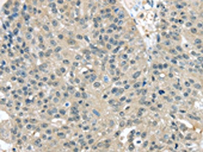 The image on the left is immunohistochemistry of paraffin-embedded Human breast cancer tissue using CSB-PA086603(TXNDC17 Antibody) at dilution 1/30, on the right is treated with fusion protein. (Original magnification: ×200)