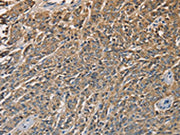 The image on the left is immunohistochemistry of paraffin-embedded Human prostate cancer tissue using CSB-PA086611(KLK1 Antibody) at dilution 1/40, on the right is treated with fusion protein. (Original magnification: ×200)