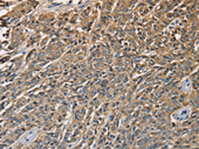 The image on the left is immunohistochemistry of paraffin-embedded Human prostate cancer tissue using CSB-PA086611(KLK1 Antibody) at dilution 1/40, on the right is treated with fusion protein. (Original magnification: ×200)