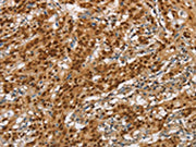 The image on the left is immunohistochemistry of paraffin-embedded Human gastic cancer tissue using CSB-PA086904(NLRP7 Antibody) at dilution 1/60, on the right is treated with synthetic peptide. (Original magnification: ×200)
