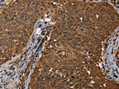 The image on the left is immunohistochemistry of paraffin-embedded Human cervical cancer tissue using CSB-PA086956(DCP1A Antibody) at dilution 1/50, on the right is treated with fusion protein. (Original magnification: ×200)