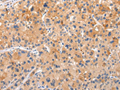 The image on the left is immunohistochemistry of paraffin-embedded Human liver cancer tissue using CSB-PA086984(AP2A1 Antibody) at dilution 1/20, on the right is treated with synthetic peptide. (Original magnification: ×200)