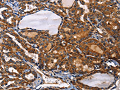 The image on the left is immunohistochemistry of paraffin-embedded Human thyroid cancer tissue using CSB-PA087041(ILK Antibody) at dilution 1/50, on the right is treated with fusion protein. (Original magnification: ×200)