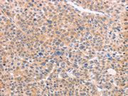 The image on the left is immunohistochemistry of paraffin-embedded Human liver cancer tissue using CSB-PA087056(NCAM1 Antibody) at dilution 1/50, on the right is treated with synthetic peptide. (Original magnification: ×200)