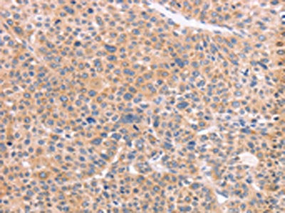 The image on the left is immunohistochemistry of paraffin-embedded Human liver cancer tissue using CSB-PA087056(NCAM1 Antibody) at dilution 1/50, on the right is treated with synthetic peptide. (Original magnification: ×200)