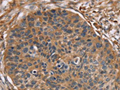 The image on the left is immunohistochemistry of paraffin-embedded Human esophagus cancer tissue using CSB-PA087089(RIPK4 Antibody) at dilution 1/40, on the right is treated with synthetic peptide. (Original magnification: ×200)
