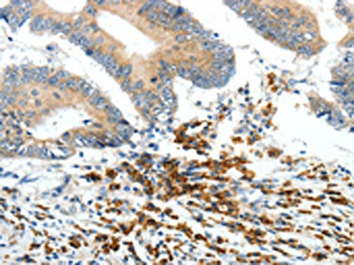 The image on the left is immunohistochemistry of paraffin-embedded Human colon cancer tissue using CSB-PA087229(PTEN Antibody) at dilution 1/20, on the right is treated with synthetic peptide. (Original magnification: ×200)