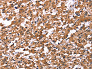 The image on the left is immunohistochemistry of paraffin-embedded Human thyroid cancer tissue using CSB-PA087383(HSD17B1 Antibody) at dilution 1/40, on the right is treated with synthetic peptide. (Original magnification: ×200)
