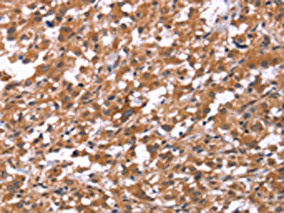 The image on the left is immunohistochemistry of paraffin-embedded Human thyroid cancer tissue using CSB-PA087383(HSD17B1 Antibody) at dilution 1/40, on the right is treated with synthetic peptide. (Original magnification: ×200)