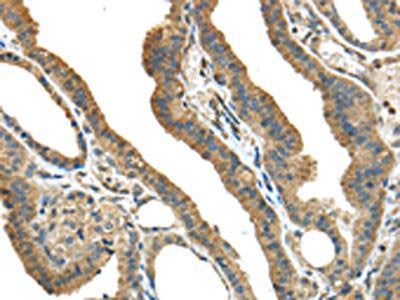 The image on the left is immunohistochemistry of paraffin-embedded Human thyroid cancer tissue using CSB-PA087395(TMPRSS13 Antibody) at dilution 1/40, on the right is treated with fusion protein. (Original magnification: ×200)