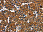 The image on the left is immunohistochemistry of paraffin-embedded Human liver cancer tissue using CSB-PA087474(CATSPER3 Antibody) at dilution 1/60, on the right is treated with fusion protein. (Original magnification: ×200)