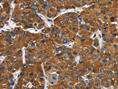 The image on the left is immunohistochemistry of paraffin-embedded Human liver cancer tissue using CSB-PA087474(CATSPER3 Antibody) at dilution 1/60, on the right is treated with fusion protein. (Original magnification: ×200)