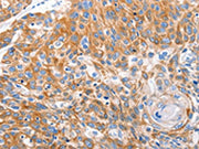 The image on the left is immunohistochemistry of paraffin-embedded Human esophagus cancer tissue using CSB-PA087523(LRP2 Antibody) at dilution 1/16, on the right is treated with synthetic peptide. (Original magnification: ×200)