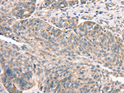 The image on the left is immunohistochemistry of paraffin-embedded Human ovarian cancer tissue using CSB-PA087606(DECR1 Antibody) at dilution 1/50, on the right is treated with synthetic peptide. (Original magnification: ×200)