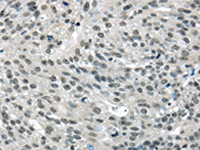 The image on the left is immunohistochemistry of paraffin-embedded Human breast cancer tissue using CSB-PA087753(MED15 Antibody) at dilution 1/20, on the right is treated with fusion protein. (Original magnification: ×200)
