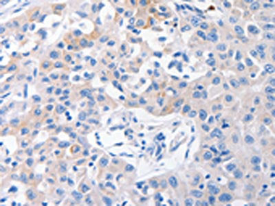 The image on the left is immunohistochemistry of paraffin-embedded Human lung cancer tissue using CSB-PA087826(SLC10A1 Antibody) at dilution 1/31, on the right is treated with synthetic peptide. (Original magnification: ×200)