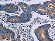 The image on the left is immunohistochemistry of paraffin-embedded Human colon cancer tissue using CSB-PA087882(ITK Antibody) at dilution 1/50, on the right is treated with fusion protein. (Original magnification: ×200)