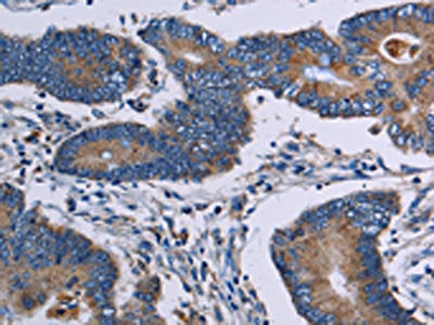 The image on the left is immunohistochemistry of paraffin-embedded Human colon cancer tissue using CSB-PA087882(ITK Antibody) at dilution 1/50, on the right is treated with fusion protein. (Original magnification: ×200)