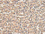 The image on the left is immunohistochemistry of paraffin-embedded Human liver cancer tissue using CSB-PA088155(VPS35 Antibody) at dilution 1/30, on the right is treated with fusion protein. (Original magnification: ×200)