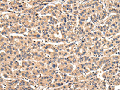 The image on the left is immunohistochemistry of paraffin-embedded Human liver cancer tissue using CSB-PA088155(VPS35 Antibody) at dilution 1/30, on the right is treated with fusion protein. (Original magnification: ×200)