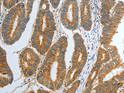 The image on the left is immunohistochemistry of paraffin-embedded Human colon cancer tissue using CSB-PA088225(RHEB Antibody) at dilution 1/30, on the right is treated with synthetic peptide. (Original magnification: ×200)