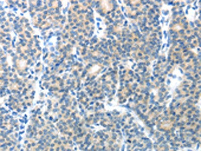 The image on the left is immunohistochemistry of paraffin-embedded Human thyroid cancer tissue using CSB-PA088258(CEACAM1 Antibody) at dilution 1/25, on the right is treated with fusion protein. (Original magnification: ×200)