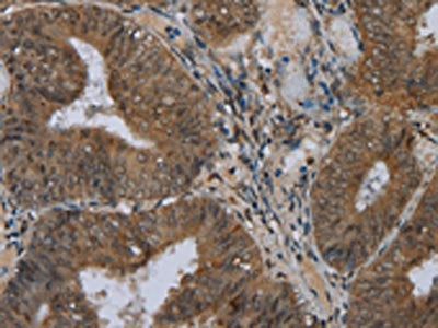 The image on the left is immunohistochemistry of paraffin-embedded Human colon cancer tissue using CSB-PA088333(NAT10 Antibody) at dilution 1/40, on the right is treated with fusion protein. (Original magnification: ×200)