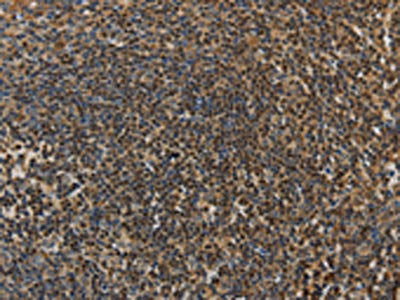 The image on the left is immunohistochemistry of paraffin-embedded Human tonsil tissue using CSB-PA088510(LEF1 Antibody) at dilution 1/20, on the right is treated with fusion protein. (Original magnification: ×200)