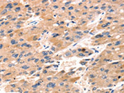 The image on the left is immunohistochemistry of paraffin-embedded Human liver cancer tissue using CSB-PA088613(TAP2 Antibody) at dilution 1/30, on the right is treated with synthetic peptide. (Original magnification: ×200)