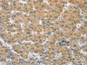 The image on the left is immunohistochemistry of paraffin-embedded Human liver cancer tissue using CSB-PA088788(CYP2C9 Antibody) at dilution 1/35, on the right is treated with fusion protein. (Original magnification: ×200)