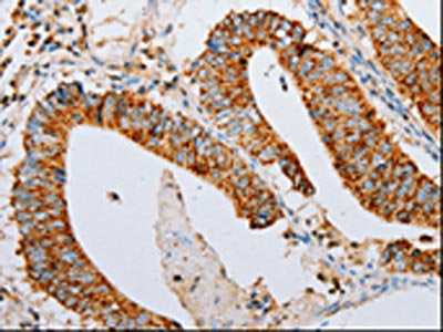 The image on the left is immunohistochemistry of paraffin-embedded Human colon cancer tissue using CSB-PA088834(ARF6 Antibody) at dilution 1/15, on the right is treated with synthetic peptide. (Original magnification: ×200)