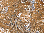 The image on the left is immunohistochemistry of paraffin-embedded Human cervical cancer tissue using CSB-PA088935(STK32B Antibody) at dilution 1/25, on the right is treated with synthetic peptide. (Original magnification: ×200)