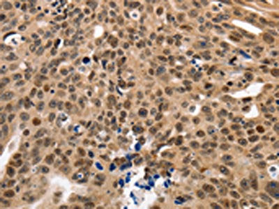 The image on the left is immunohistochemistry of paraffin-embedded Human ovarian cancer tissue using CSB-PA089095(NAIF1 Antibody) at dilution 1/60, on the right is treated with fusion protein. (Original magnification: ×200)