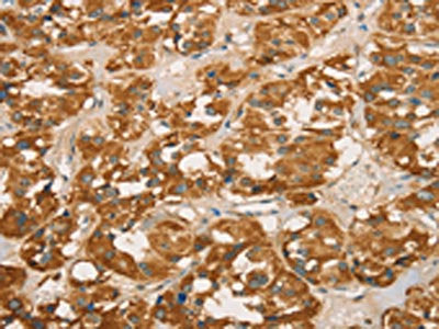 The image on the left is immunohistochemistry of paraffin-embedded Human thyroid cancer tissue using CSB-PA089183(RBBP8 Antibody) at dilution 1/65, on the right is treated with fusion protein. (Original magnification: ×200)