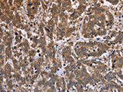The image on the left is immunohistochemistry of paraffin-embedded Human liver cancer tissue using CSB-PA089265(FBP2 Antibody) at dilution 1/40, on the right is treated with fusion protein. (Original magnification: ×200)