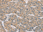 The image on the left is immunohistochemistry of paraffin-embedded Human liver cancer tissue using CSB-PA089355(RBM38 Antibody) at dilution 1/35, on the right is treated with synthetic peptide. (Original magnification: x200)