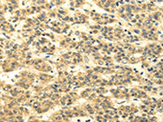 The image on the left is immunohistochemistry of paraffin-embedded Human liver cancer tissue using CSB-PA089533(MSI1 Antibody) at dilution 1/35, on the right is treated with synthetic peptide. (Original magnification: ×200)