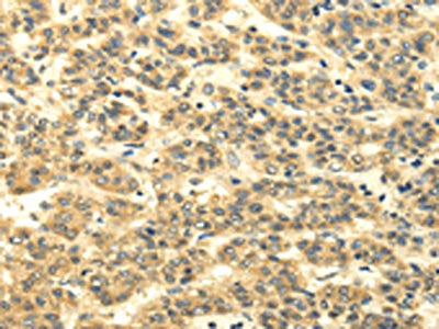 The image on the left is immunohistochemistry of paraffin-embedded Human liver cancer tissue using CSB-PA089533(MSI1 Antibody) at dilution 1/35, on the right is treated with synthetic peptide. (Original magnification: ×200)