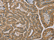 The image on the left is immunohistochemistry of paraffin-embedded Human thyroid cancer tissue using CSB-PA089757(MVK Antibody) at dilution 1/40, on the right is treated with fusion protein. (Original magnification: ×200)