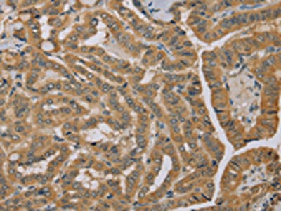 The image on the left is immunohistochemistry of paraffin-embedded Human thyroid cancer tissue using CSB-PA089757(MVK Antibody) at dilution 1/40, on the right is treated with fusion protein. (Original magnification: ×200)