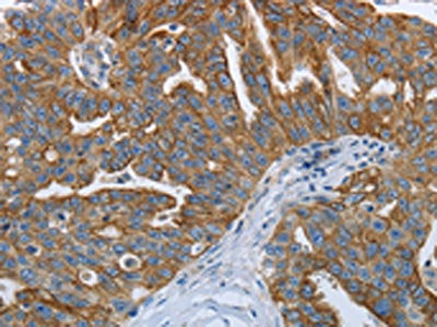 The image on the left is immunohistochemistry of paraffin-embedded Human ovarian cancer tissue using CSB-PA090129(RETN Antibody) at dilution 1/20, on the right is treated with fusion protein. (Original magnification: ×200)