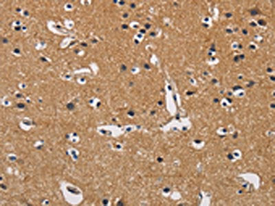 The image on the left is immunohistochemistry of paraffin-embedded Human brain tissue using CSB-PA090179(CBY1 Antibody) at dilution 1/60, on the right is treated with fusion protein. (Original magnification: ×200)