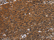 The image on the left is immunohistochemistry of paraffin-embedded Human cervical cancer tissue using CSB-PA090243(PNOC Antibody) at dilution 1/40, on the right is treated with synthetic peptide. (Original magnification: ×200)