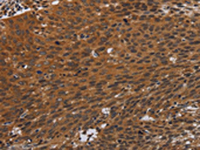 The image on the left is immunohistochemistry of paraffin-embedded Human cervical cancer tissue using CSB-PA090243(PNOC Antibody) at dilution 1/40, on the right is treated with synthetic peptide. (Original magnification: ×200)