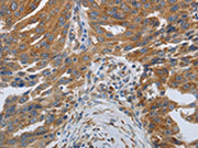 The image on the left is immunohistochemistry of paraffin-embedded Human ovarian cancer tissue using CSB-PA090256(SPAG1 Antibody) at dilution 1/25, on the right is treated with synthetic peptide. (Original magnification: ×200)