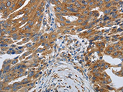 The image on the left is immunohistochemistry of paraffin-embedded Human ovarian cancer tissue using CSB-PA090256(SPAG1 Antibody) at dilution 1/25, on the right is treated with synthetic peptide. (Original magnification: ×200)