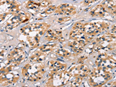 The image on the left is immunohistochemistry of paraffin-embedded Human thyroid cancer tissue using CSB-PA090482(ATRN Antibody) at dilution 1/30, on the right is treated with synthetic peptide. (Original magnification: ×200)