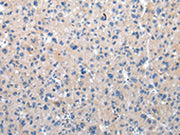 The image on the left is immunohistochemistry of paraffin-embedded Human liver cancer tissue using CSB-PA090580(ZFAND2A Antibody) at dilution 1/30, on the right is treated with synthetic peptide. (Original magnification: ×200)