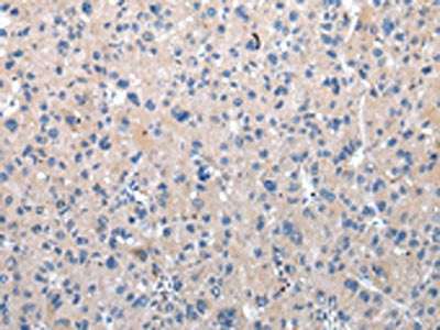 The image on the left is immunohistochemistry of paraffin-embedded Human liver cancer tissue using CSB-PA090580(ZFAND2A Antibody) at dilution 1/30, on the right is treated with synthetic peptide. (Original magnification: ×200)