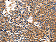 The image on the left is immunohistochemistry of paraffin-embedded Human liver cancer tissue using CSB-PA090613(IRF1 Antibody) at dilution 1/40, on the right is treated with synthetic peptide. (Original magnification: ×200)